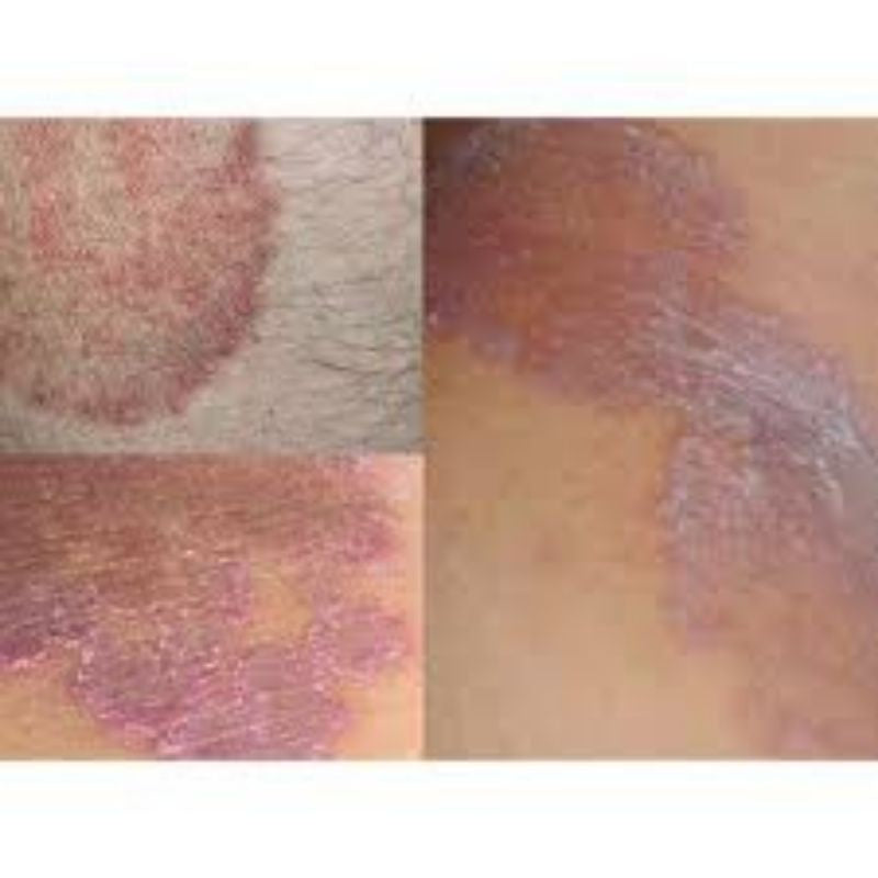 READY STOCK!!!DERMAHEU CREAM ( for dermatitis treatment) Original THAILAND 祛脚气